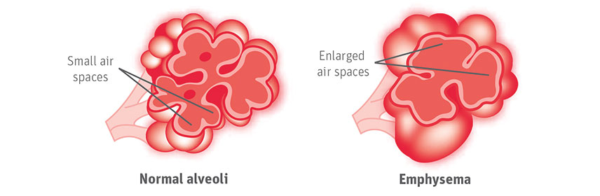 Portable Oxygen cylinderned for emphysema