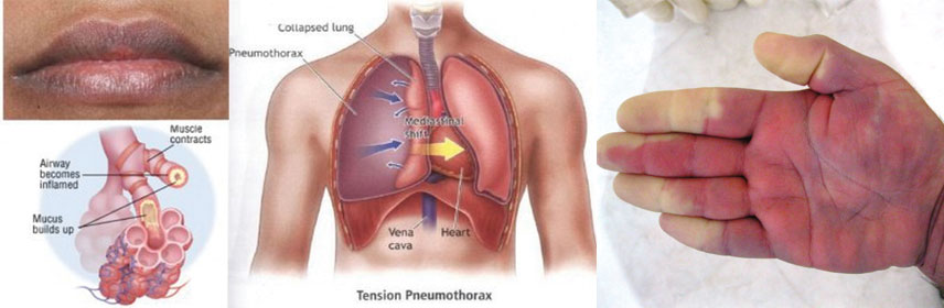 Medical Oxygen cylinder for hypoxemia